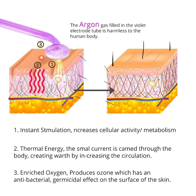 High Frequency Facial Device (Argon Gas) for Acne/Antibacterial
